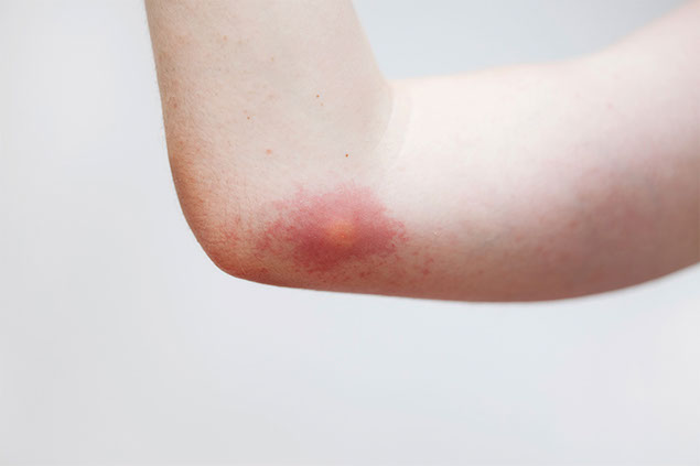 Image of arm with an insect bite mark.