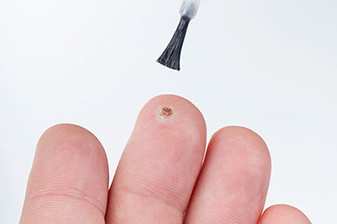 Image of medication being applied to wart on finger.