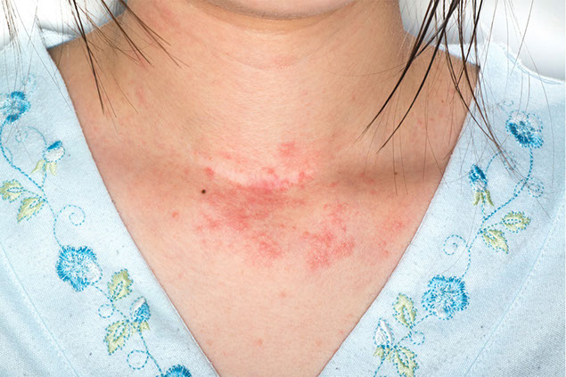 Image of a hive rash below neck.