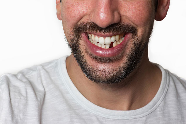 Close up image of man smiling with missing bottom tooth.