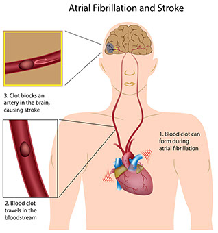 Illustration of how a stroke is caused.