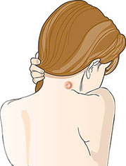 Illustration of a boil.