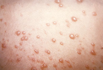 Image of the shingles.