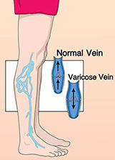 Illustration of varicose veins.