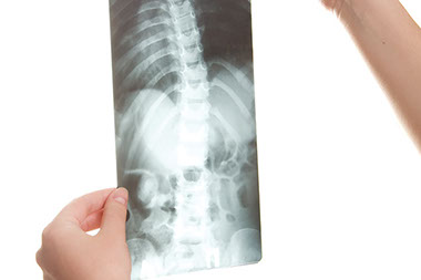 Image of a X-ray of the spine.