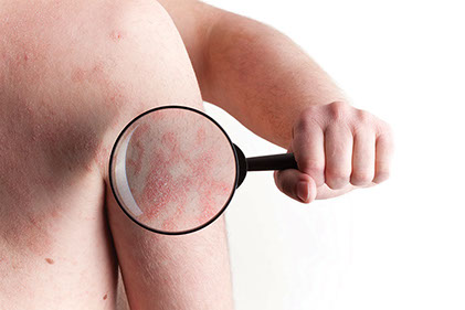 Close up image of psoriasis on arm.