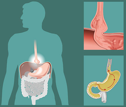 Illustration of a hernia.