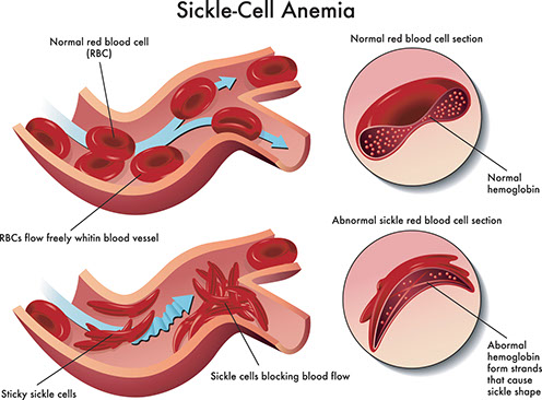 Illustration of sickle cell anemia.