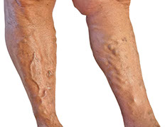 Image of varicose veins.