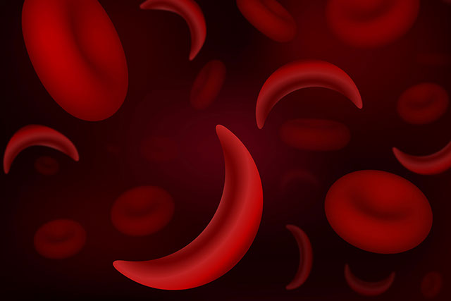 Illustration of sickle cell anemia.
