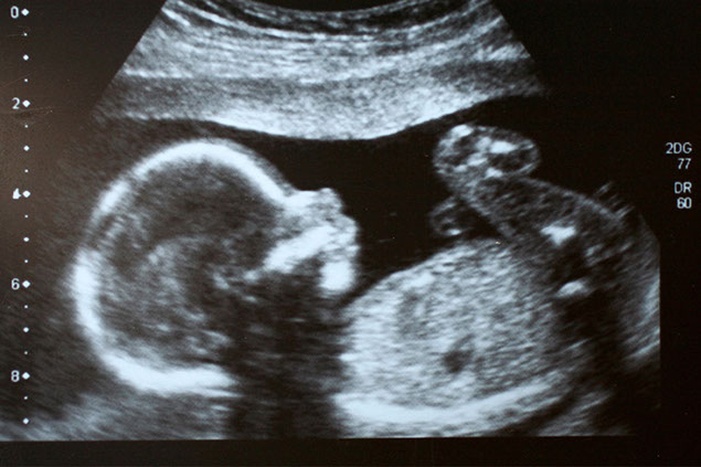 Image of baby in the womb from an ultrasound.