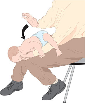 Illustration on giving a baby first aid when choking.