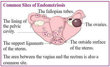 Common sites of endometriosis.