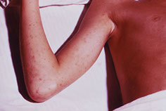 Image of rocky mountain rash.
