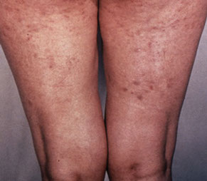 Image of roseola rash.