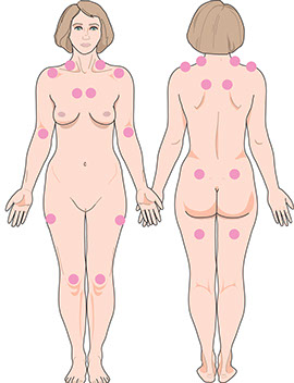 Illustration of fibromyalgia spots.