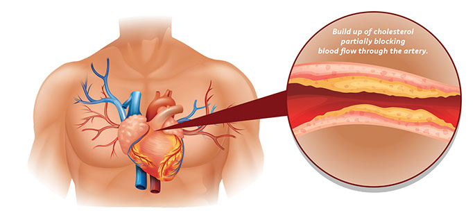 Illustration of a heart with a pop out illustration of a build up in an artery.