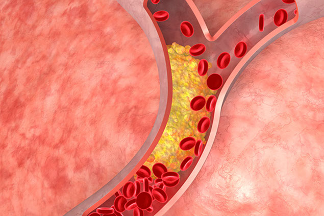 Illustration of artery having plaque buildup narrowing blood flow.