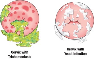 Why do i keep getting bv and yeast on sale infections at the same time